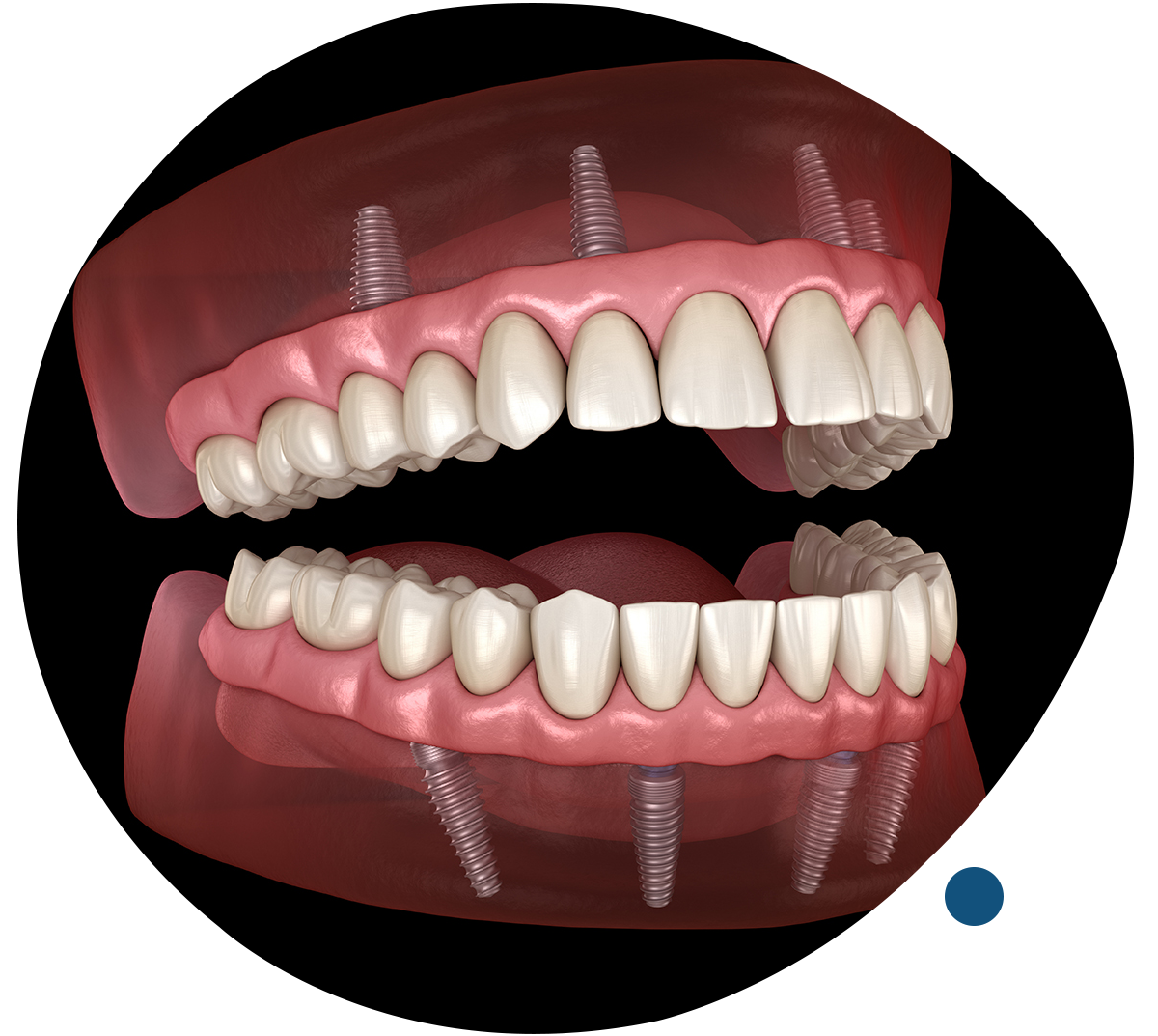 Full Mouth Dental Implant Package