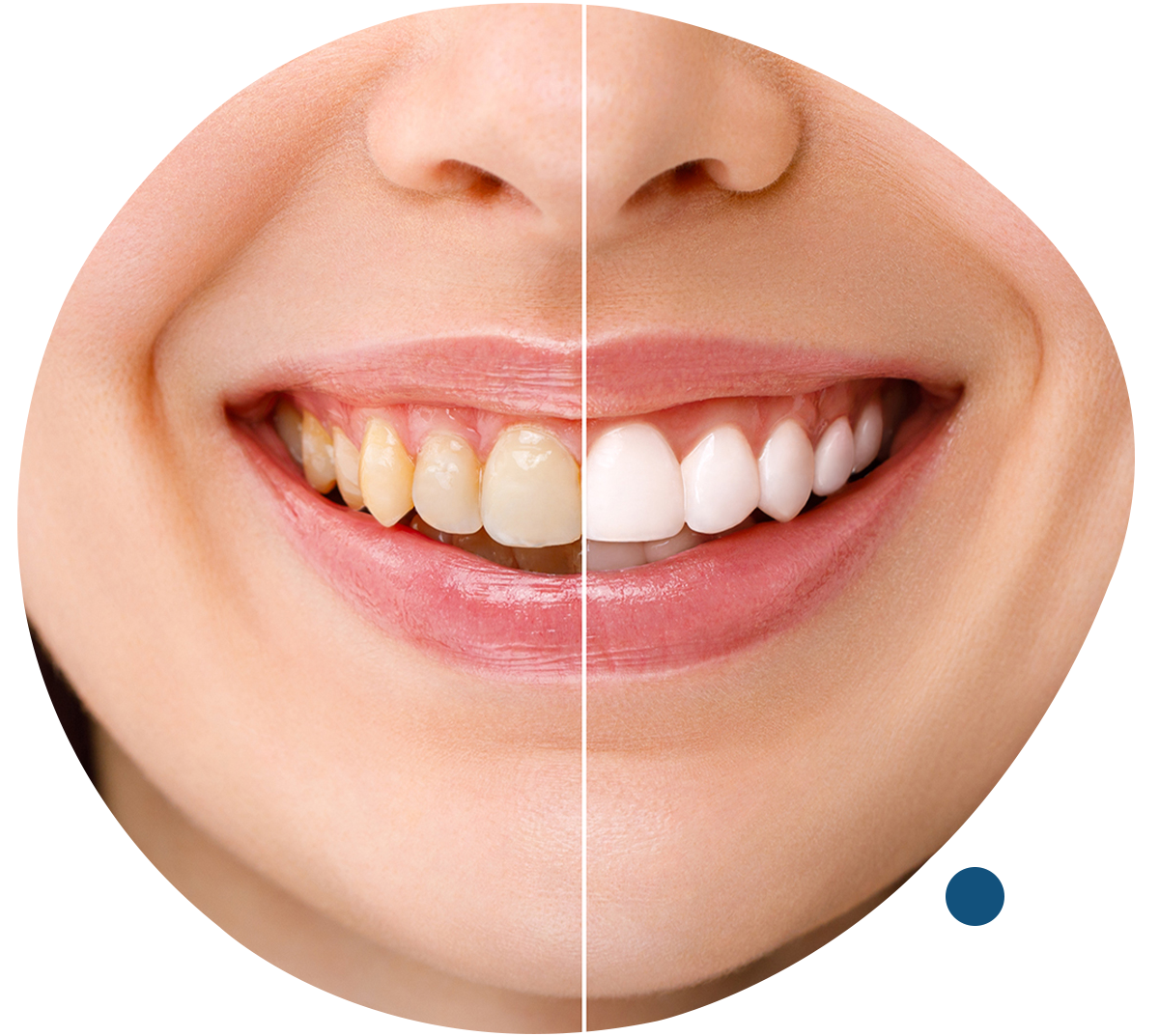 Teeth Whitening/ Bleaching